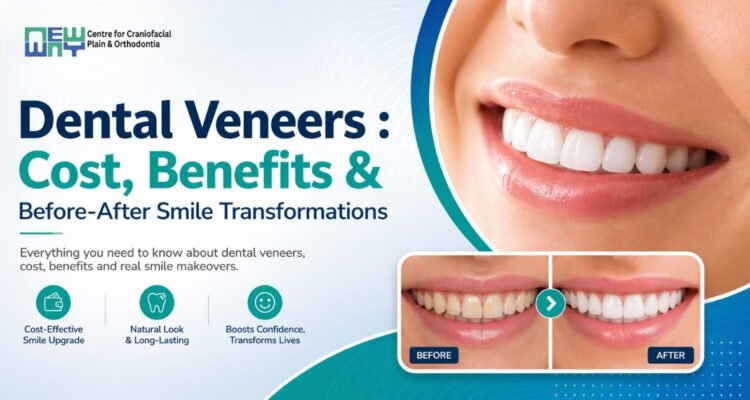 Dental Veneers in Chandigarh