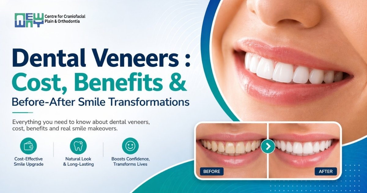 Dental Veneers in Chandigarh