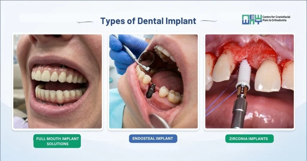 dental implants in Chandigarh