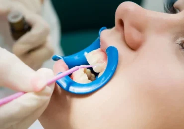 Fluoride Therapy