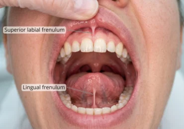 Frenectomy