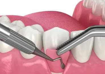 gingival flap surgery
