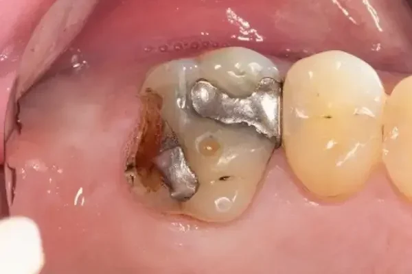 Teeth Fillings Chandigarh, (3)